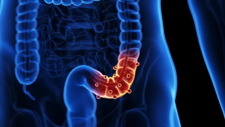 Diverticolite: fibra più, Meno infiammazieone